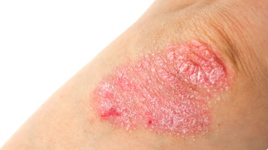 How To Use Apple Cider Vinegar for Psoriasis