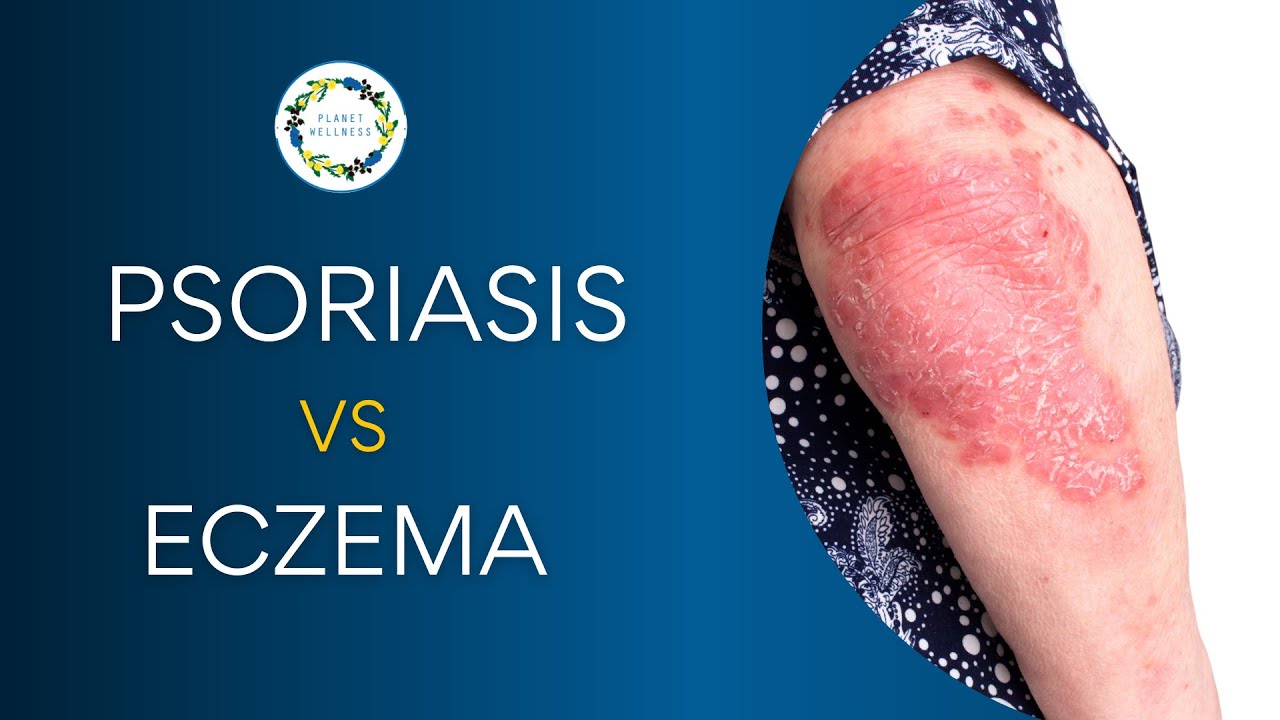 Psoriasis Vs Eczema Organic Health Solutions
