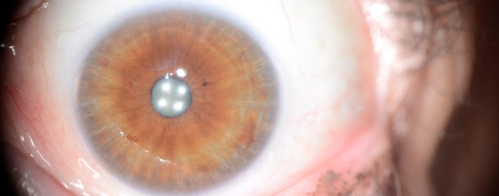 Iridology Pictures and Meanings