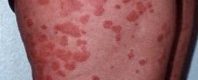 What Causes Psoriasis?