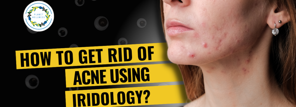 How To Get Rid Of Acne Using Iridology