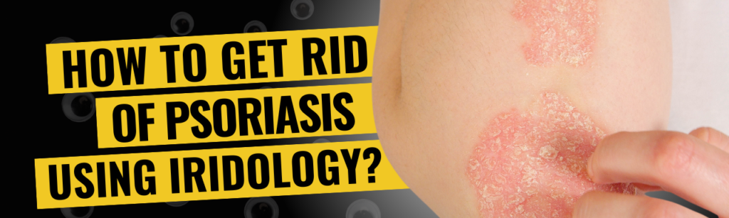How To Get Rid Of Psoriasis Using Iridology
