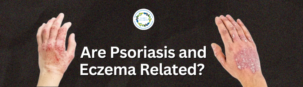 Are Psoriasis and Eczema Related?