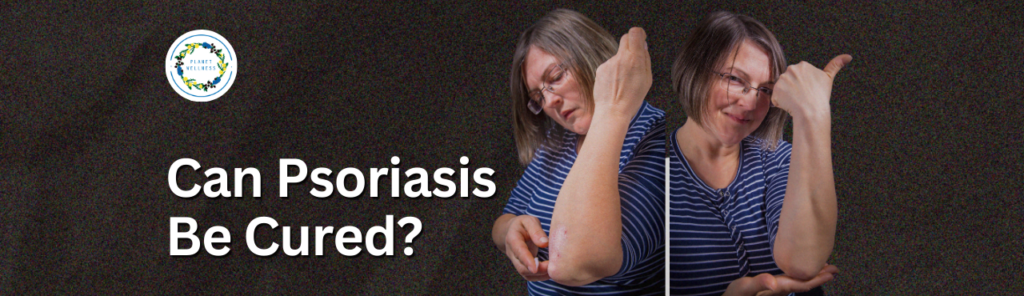 Can Psoriasis Be Cured?