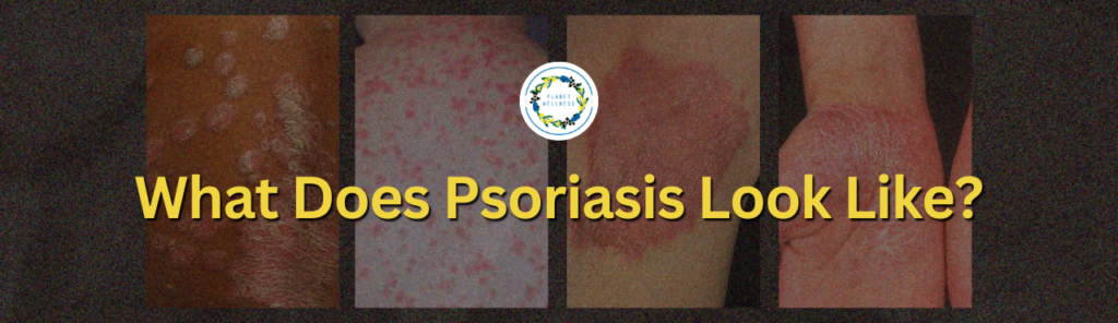 What Does Psoriasis Look Like?