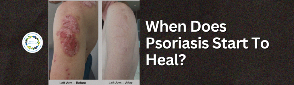 When Does Psoriasis Start To Heal?