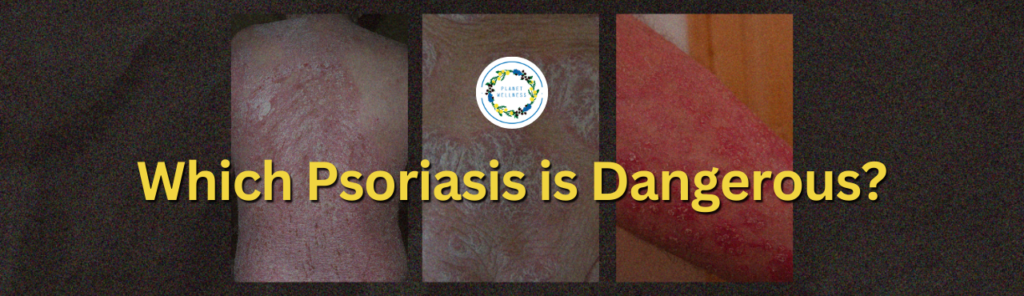 Which Psoriasis Is Dangerous?