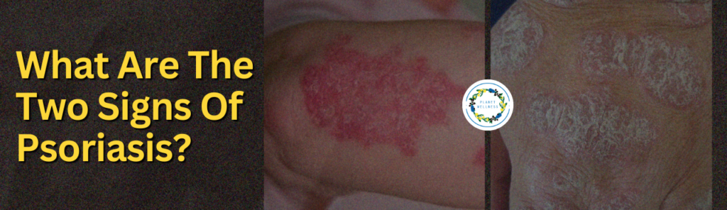 What Are The Two Signs Of Psoriasis?