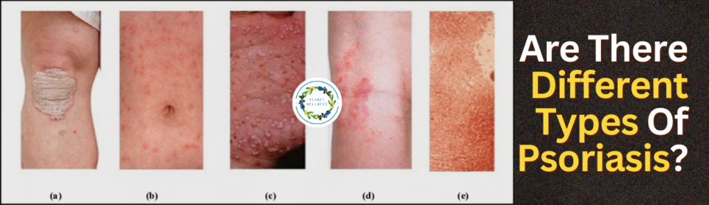 Are there different types of Psoriasis?