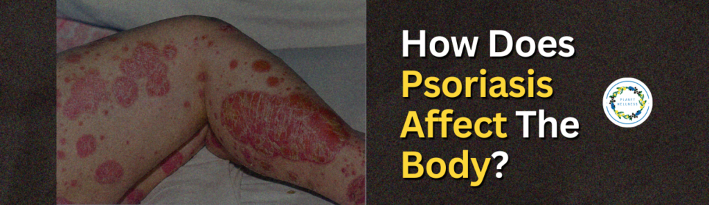 How Does Psoriasis Affect The Body?