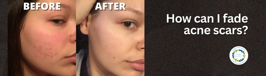 How can I fade acne scars?