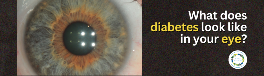 What does Diabetes look like in your eye?