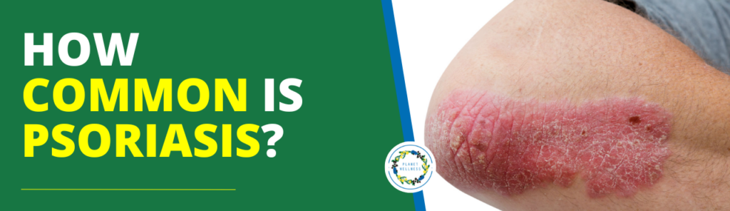 How common is Psoriasis?