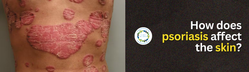 How does Psoriasis affect the skin?