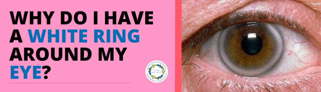 Why do I have a white ring around my eye?