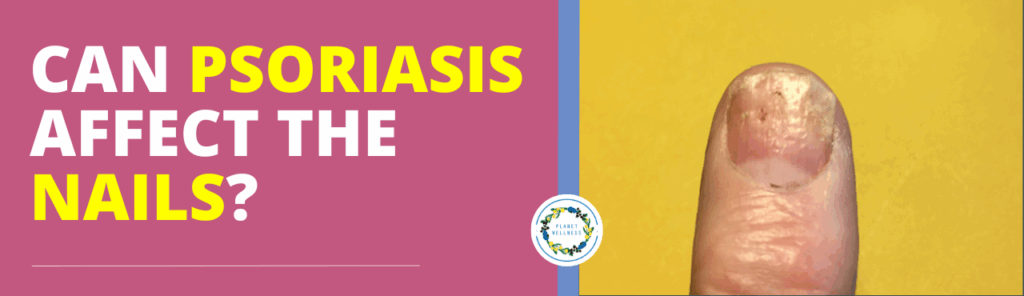 Can Psoriasis affect the nails?