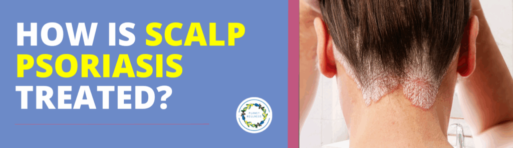 How is Scalp Psoriasis treated?