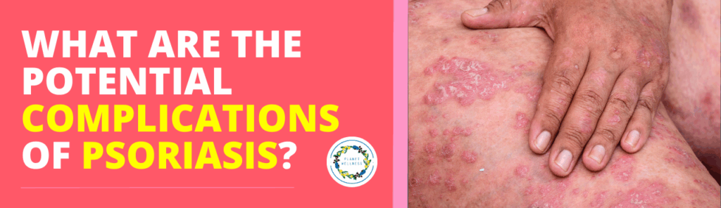 What are the potential complications of Psoriasis?