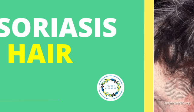 Can Psoriasis cause hair loss?