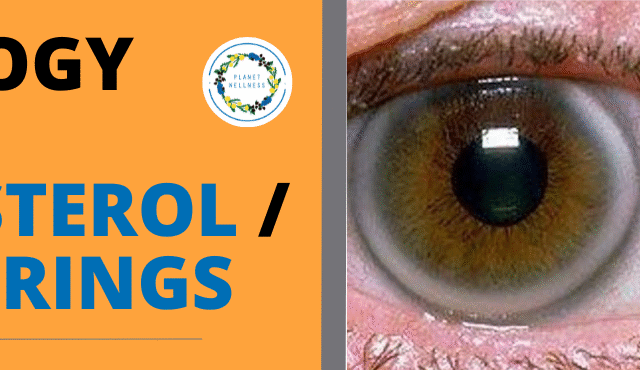 Iridology lesson – cholesterol and lymph rings