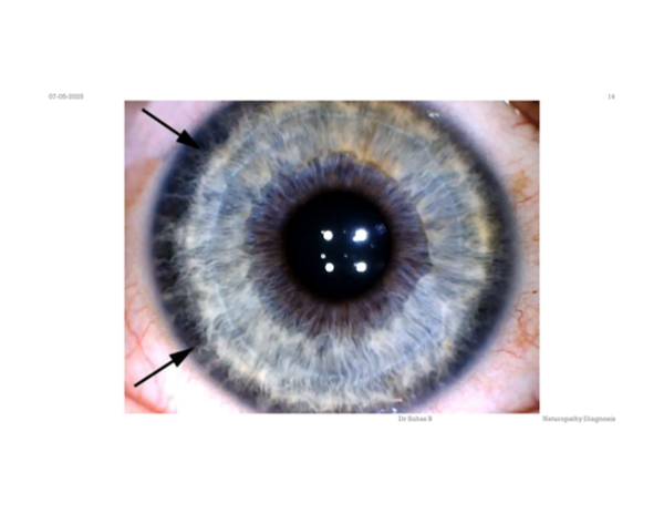 Scurf Rim Vs Regular Rim Iridology lesson – Skin rings how to spot and detox it out - Organic ...